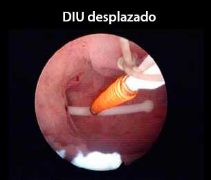 DIU desplazado