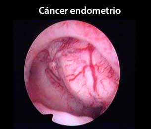 Cáncer endometrio