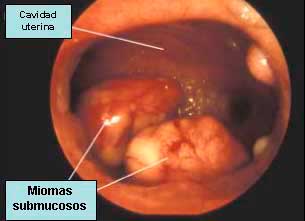 miomas submucosos